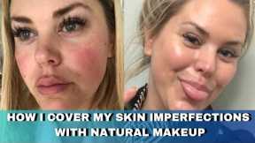 How I Cover My Skin Imperfections with Makeup that looks Natural  / Acne, Melasma, Rosacea, Scarring