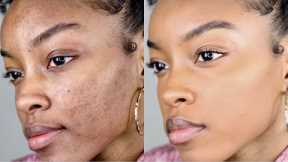 How to cover acne/dark spots WITHOUT a lot of makeup | Slim Reshae