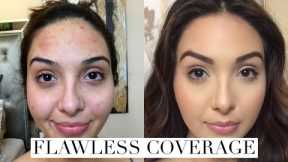 How to Cover Acne Breakouts & Dark Spots with Makeup