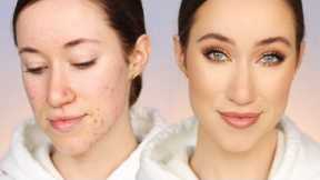 How I Cover My Acne (All Drugstore Makeup) 🙌🏼