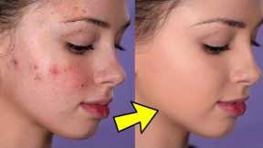 How To Cover Acne and Blemishes  ( EASY & NON-CAKEY )